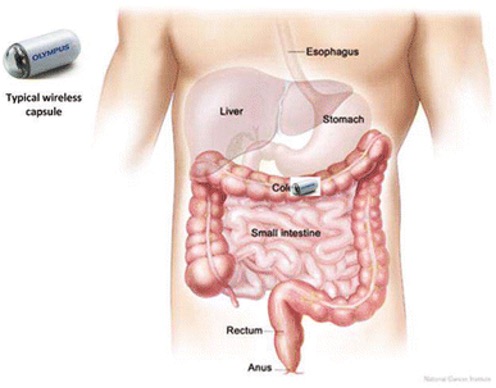 Localisation of implanted endoscope in the digestive system 